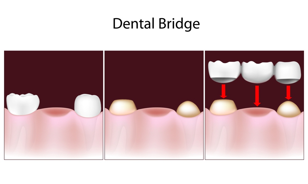 variants of dental bridges suitable for you
