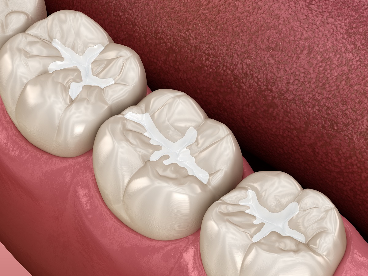 how durable are composite fillings